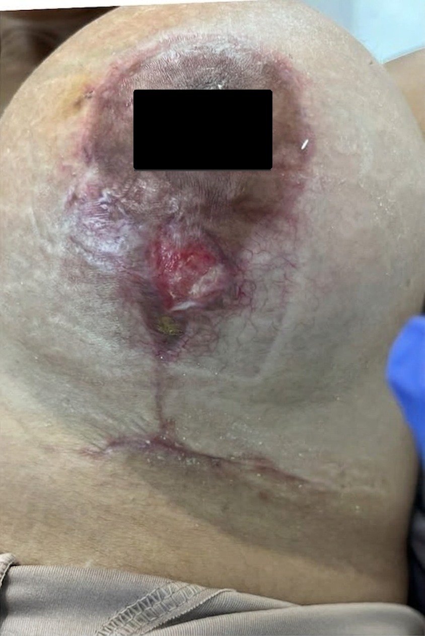 Deiscência de cirurgia plástica — antes do tratamento