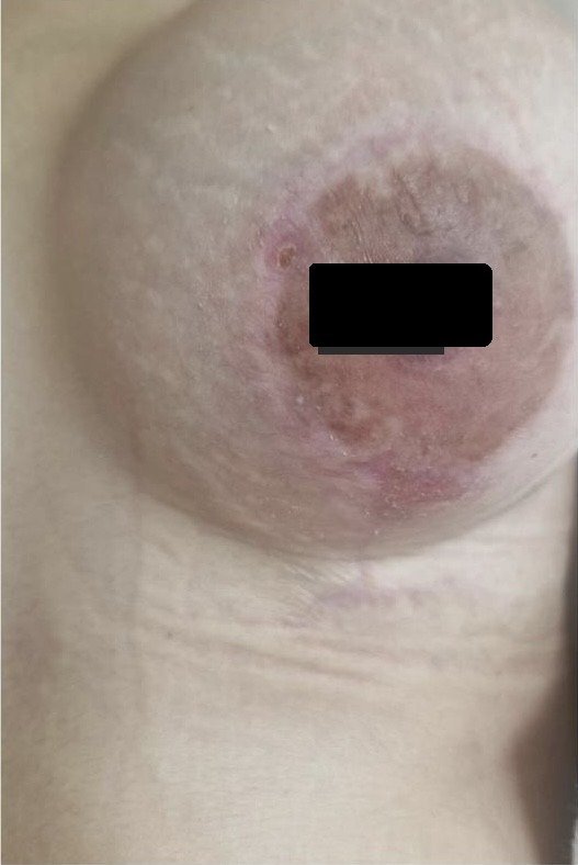 Deiscência de cirurgia plástica — depois do tratamento