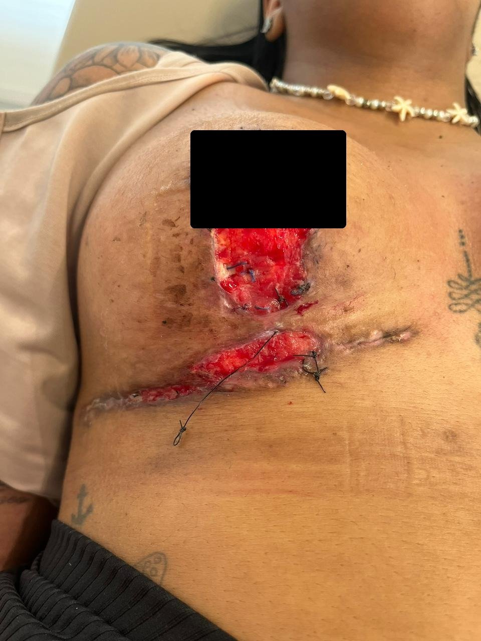 Complicação de cirurgia plástica — antes do tratamento