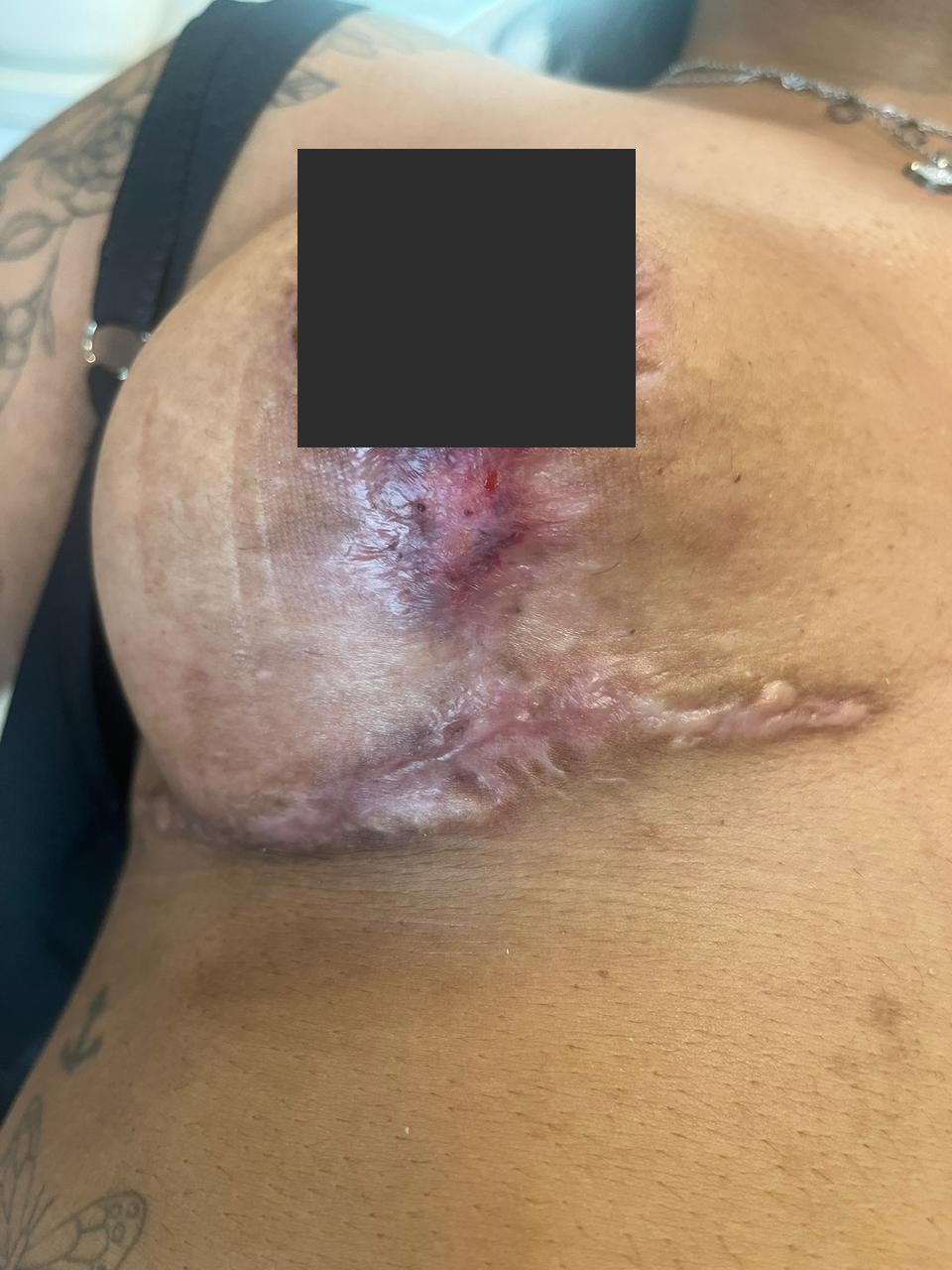 Complicação de cirurgia plástica — depois do tratamento