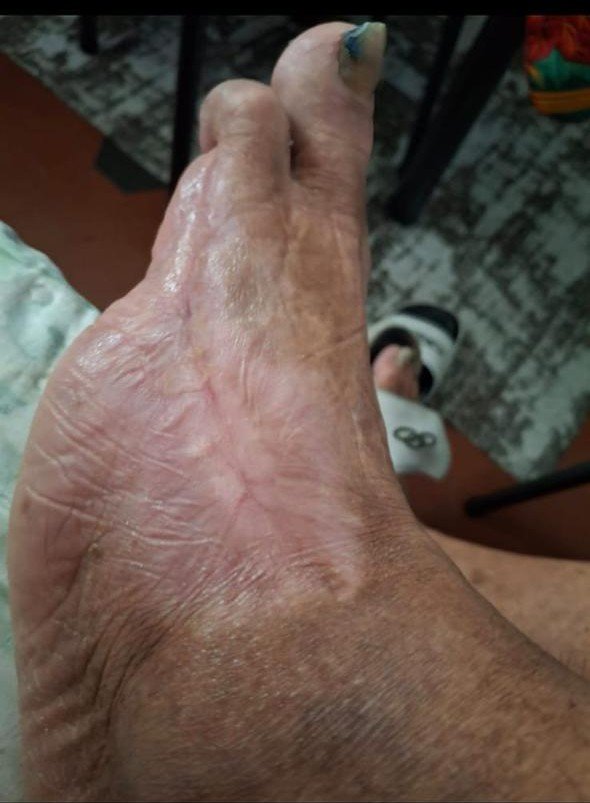 Lesão no pé de quem tem diabetes — depois do tratamento